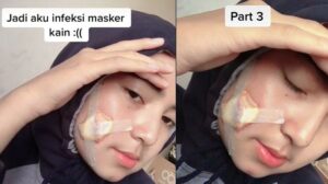 Viral! Infeksi Masker Kain, Awalnya Jerawat Lalu Luka Makin Parah Berujung Operasi