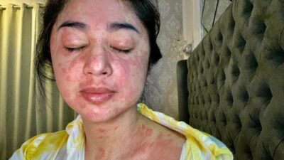 Positif Terpapar COVID-19, Wajah dan Tubuh Dewi Perssik Penuh Ruam Merah