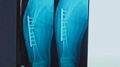 Miris! Gara-Gara Dibully Teman Sekelas, Tulang Paha Siswa SMP Di Banyuwangi Ini Harus Dipotong 4 cm