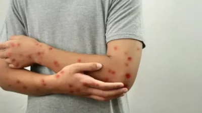 Ini Enam Gejala Serius Tanda Bahaya Mpox Yang Patut Diwaspadai