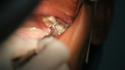 Geger! Pria di Padang Pariaman Ngaku Buta Usai Cabut Gigi di Klinik, Korban Malpraktik?