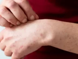 WN Australia Terinfeksi Campak Usai Kunjungi Indonesia, Kemenkes Percepat Imunisasi MR Untuk Anak PAUD/TK
