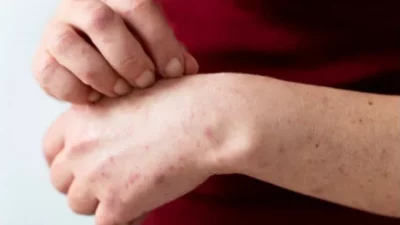 Kemenkes Wanti-wanti Potensi Penyebaran Campak Saat Kumpul dan Silaturahmi Lebaran